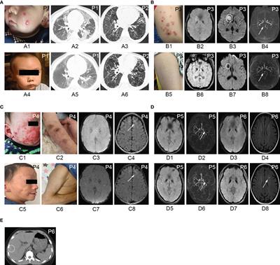 Janus Kinase Inhibitors in the Treatment of Type I Interferonopathies: A Case Series From a Single Center in China